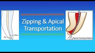 Zipping and Apical Transportation in Endodontics [upl. by Reinar]